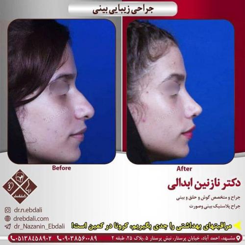 جراحی-بینی-412