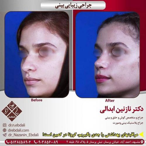 جراحی-بینی-413