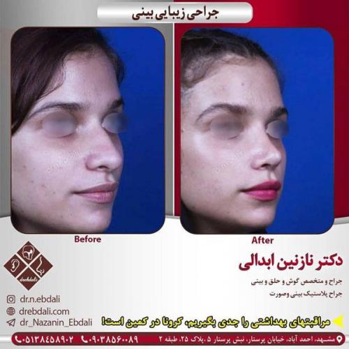 جراحی-بینی-414