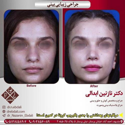جراحی-بینی-415