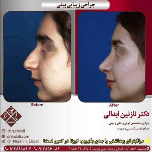 جراحی-بینی-416