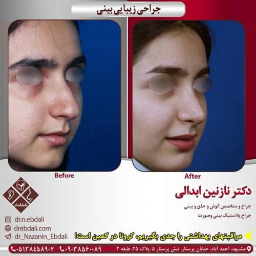 جراحی-بینی-417