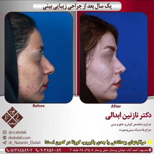 جراحی-بینی-419