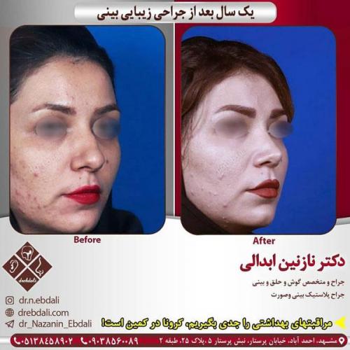 جراحی-بینی-420