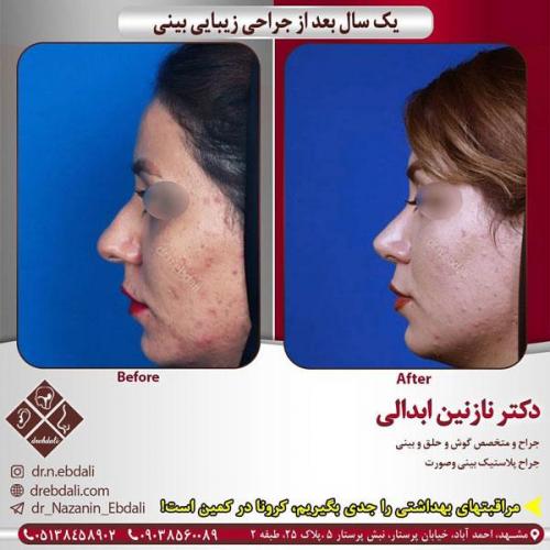 جراحی-بینی-421