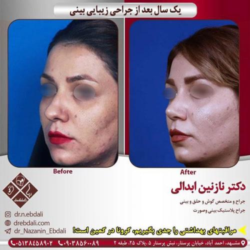 جراحی-بینی-422