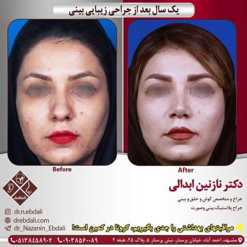جراحی-بینی-423