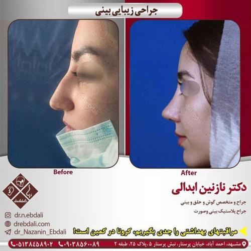 جراحی-بینی-424