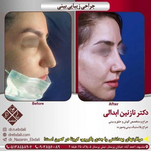 جراحی-بینی-425