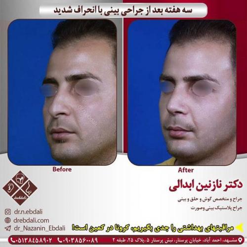 جراحی-بینی-426