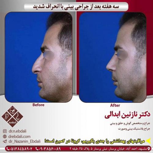 جراحی-بینی-427