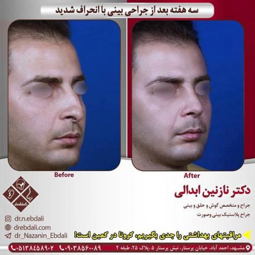 جراحی-بینی-428