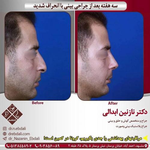 جراحی-بینی-429