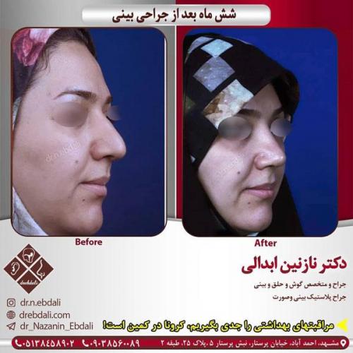 جراحی-بینی-431