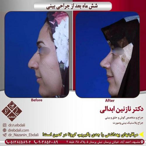 جراحی-بینی-432