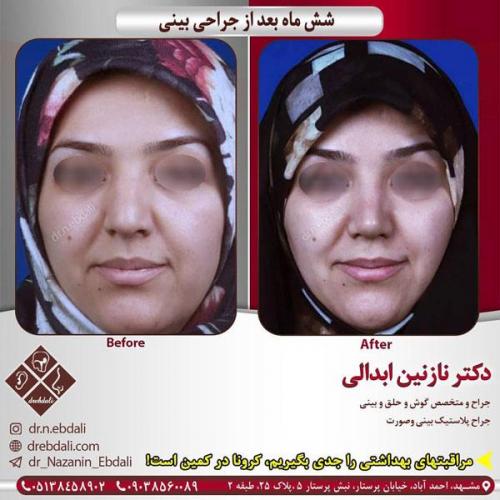 جراحی-بینی-433