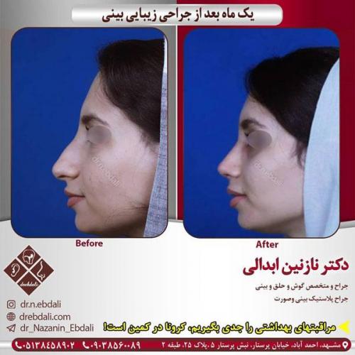 جراحی-بینی-434