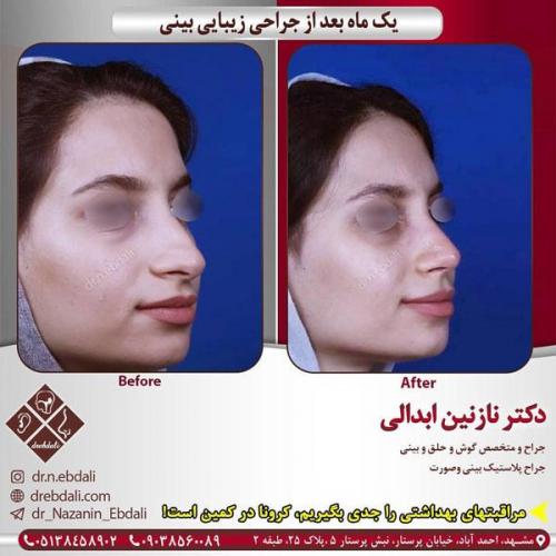 جراحی-بینی-435