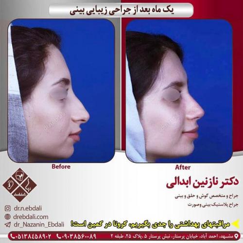 جراحی-بینی-436