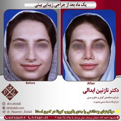 جراحی-بینی-437