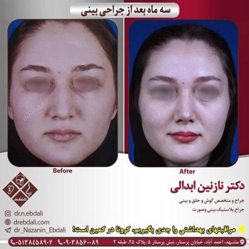 جراحی-بینی-448