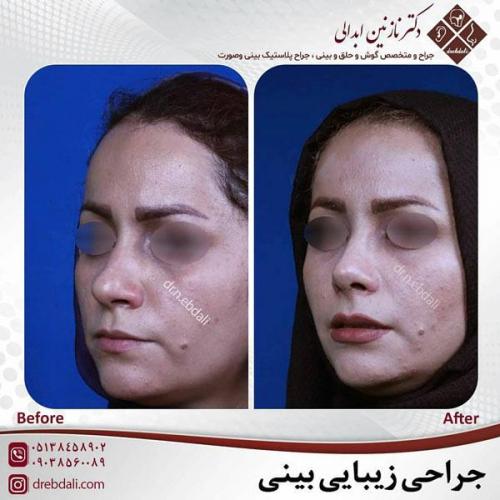 جراحی-بینی-449