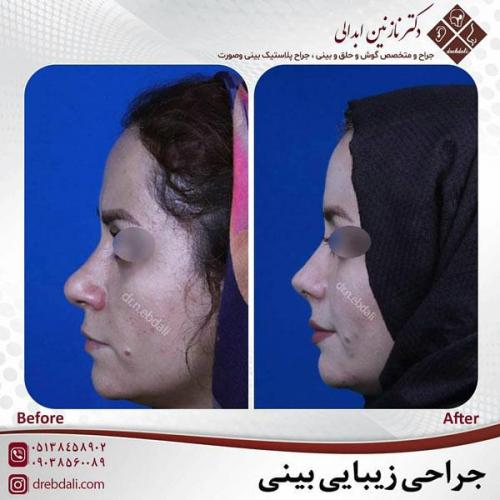 جراحی-بینی-450