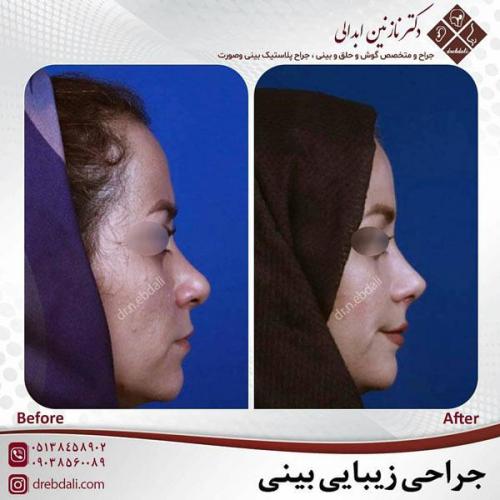 جراحی-بینی-451