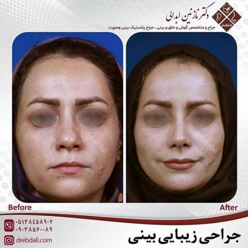 جراحی-بینی-452