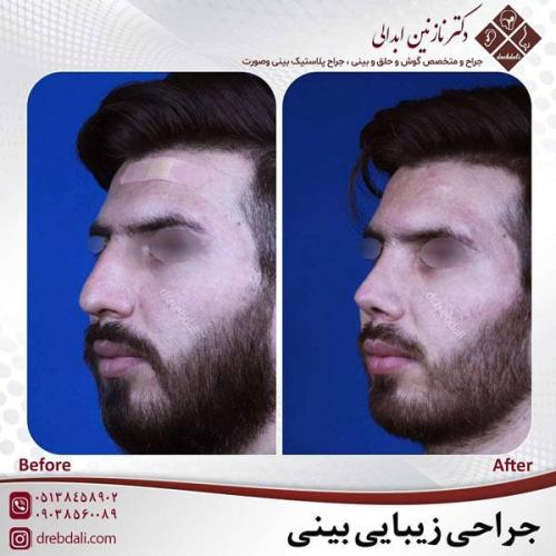 جراحی-بینی-453
