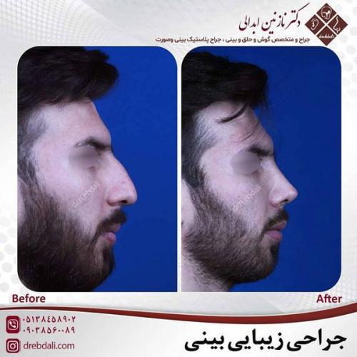 جراحی-بینی-454