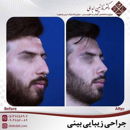 جراحی-بینی-455