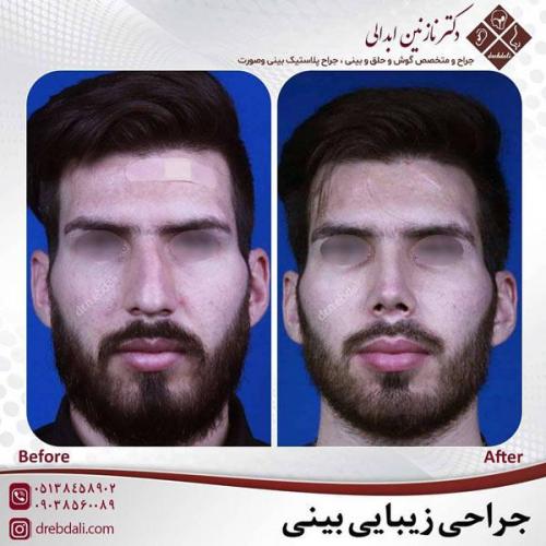 جراحی-بینی-456