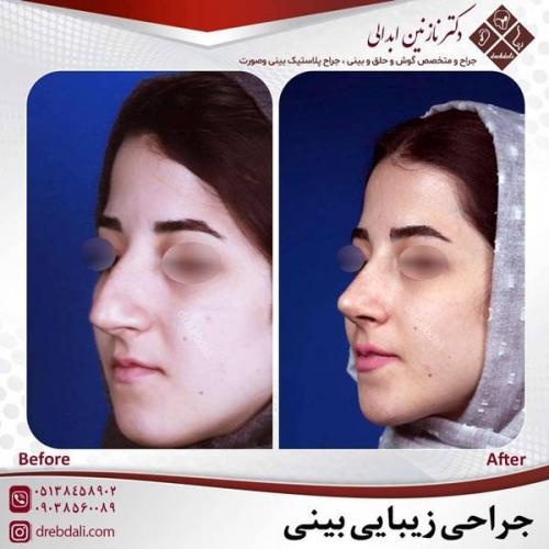 جراحی-بینی-457