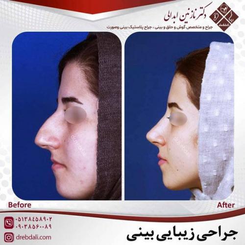 جراحی-بینی-458