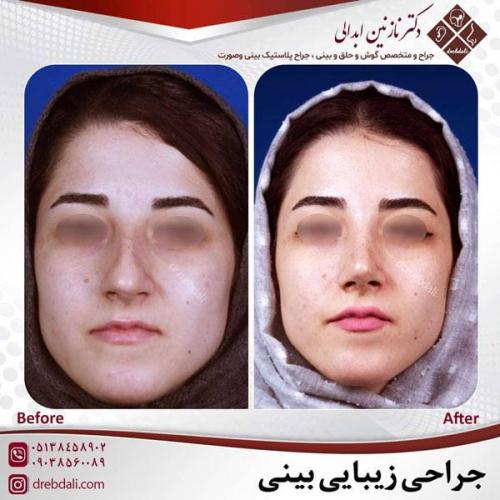 جراحی-بینی-459