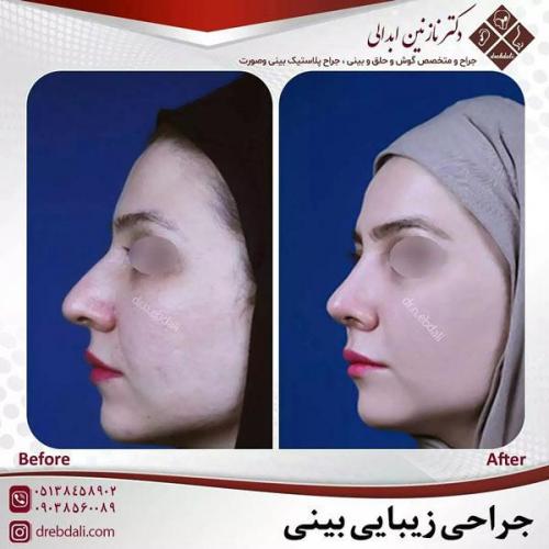 جراحی-بینی-460