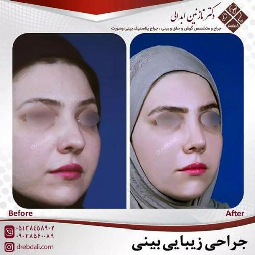 جراحی-بینی-461