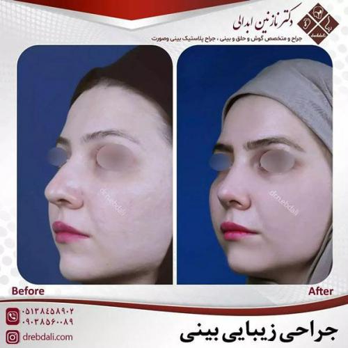 جراحی-بینی-462