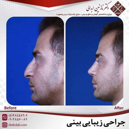 جراحی-بینی-463