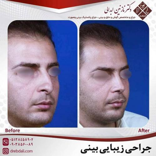 جراحی-بینی-464