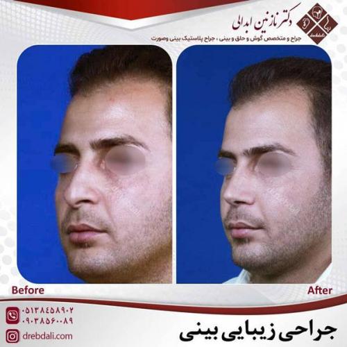 جراحی-بینی-465