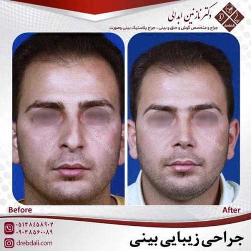 جراحی-بینی-466