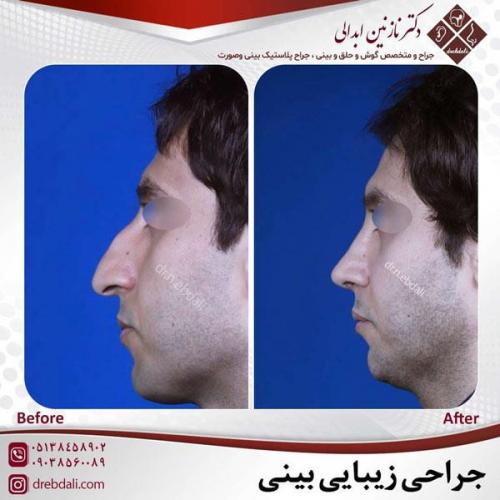 جراحی-بینی-467