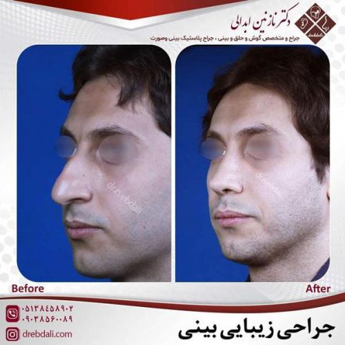 جراحی-بینی-468