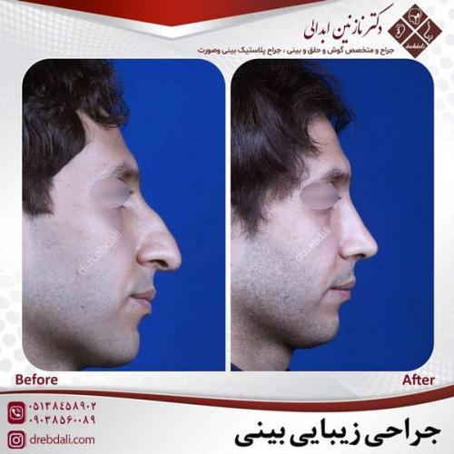 جراحی-بینی-469