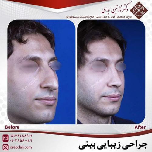 جراحی-بینی-470