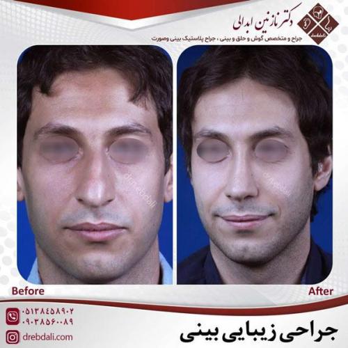 جراحی-بینی-471