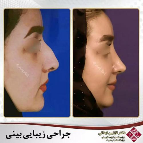 جراحی-بینی-472