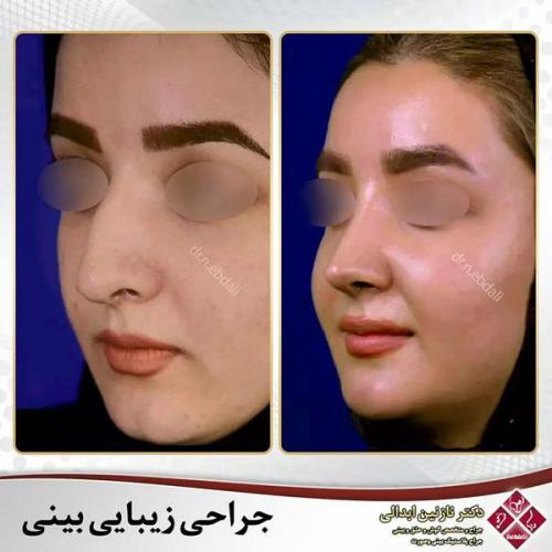 جراحی-بینی-474